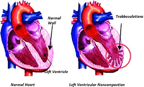 lv noncompaction|lv noncompaction cardiomyopathy.